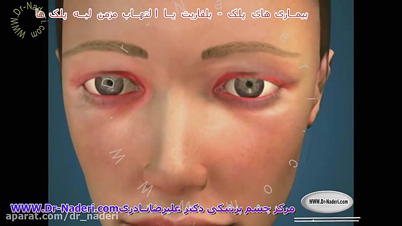 بلفاریت یا التهاب لبه پلکها - مرکز چشم پزشکی دکتر علیرضا نادری مرکز چشم پزشکی دکتر علیرضا نادری www.dr-naderi.com