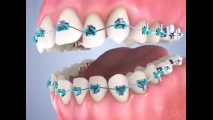نحوه ی قرار گرفتن براکت دکتر سهیل سالاری