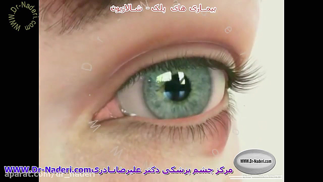 شالازیون - مرکز چشم پزشکی دکتر علیرضا نادری مرکز چشم پزشکی دکتر علیرضا نادری www.dr-naderi.com