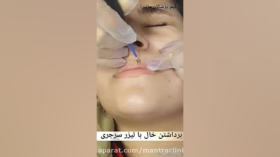 برداشتن خال با لیزر سرجری تزریق بوتاکس