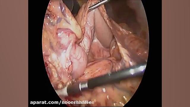 جراحی سرطان معده قسمت اول اندودنتیکس