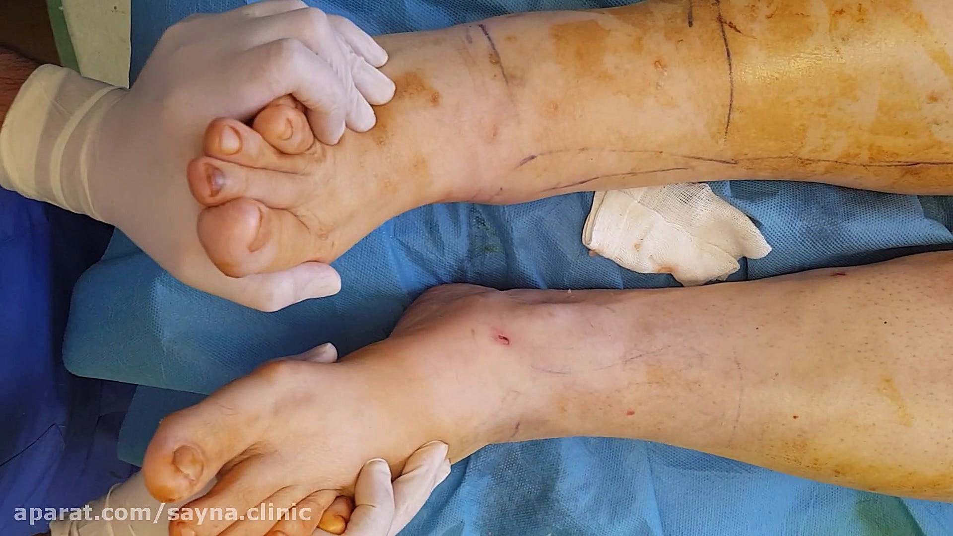 لیپوماتیک ساق پا و مچ پا توسط کلینیک تخصصی ساینا.شماره ی تماس 09388529482 آوتوپلیسوماب