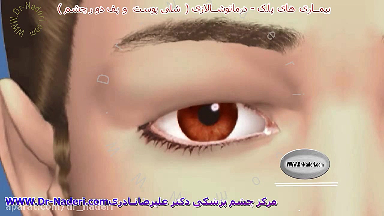 درماتوشالازی چیست؟مرکز چشم پزشکی دکتر علیرضا نادری مرکز چشم پزشکی دکتر علیرضا نادری www.dr-naderi.com
