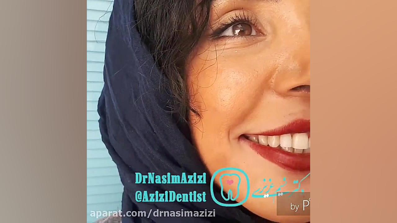 اصلاح لبخند لثه ای (Gummy Smile) با جراحی افزایش طول تا سندرم تریشن-کولینز نادر