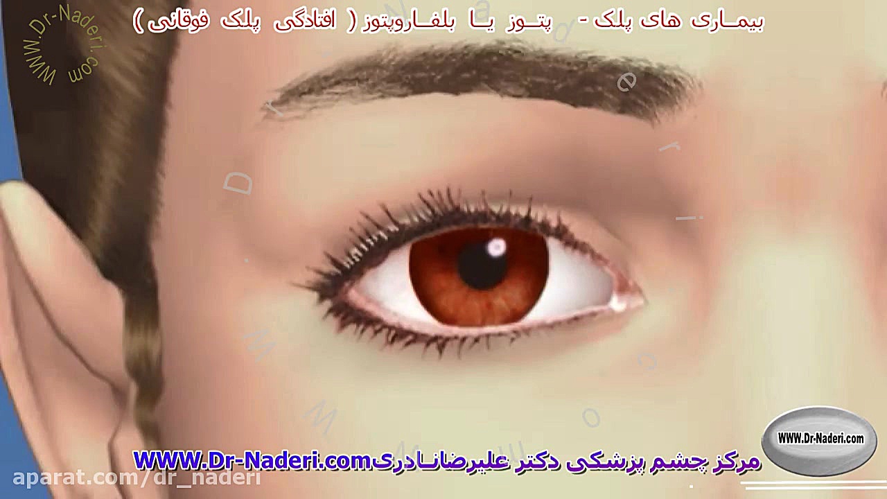 پتوز یا افتادگی پلک - مرکز چشم پزشکی دکتر علیرضا نادری مرکز چشم پزشکی دکتر علیرضا نادری www.dr-naderi.com