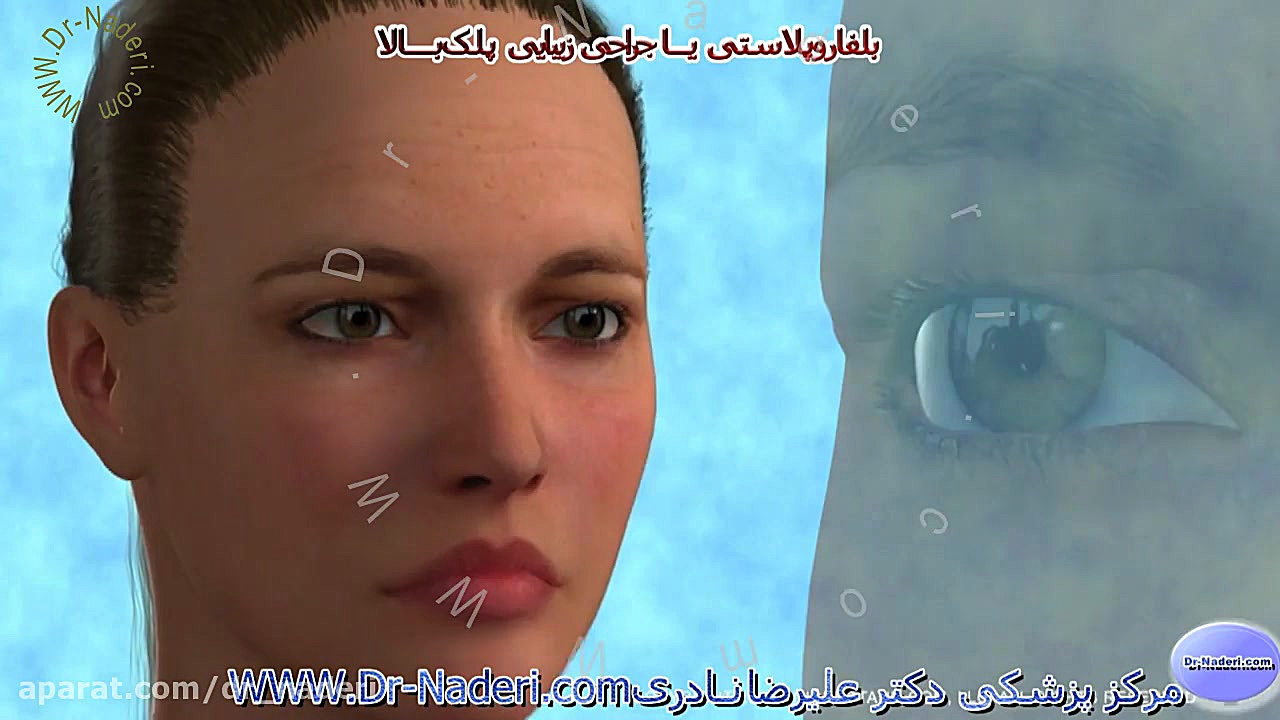 بلفاروپلاستی یا جراحی زیبایی پلک بالا - مرکز چشم پزشکی دکتر علیرضا نادری مرکز چشم پزشکی دکتر علیرضا نادری www.dr-naderi.com