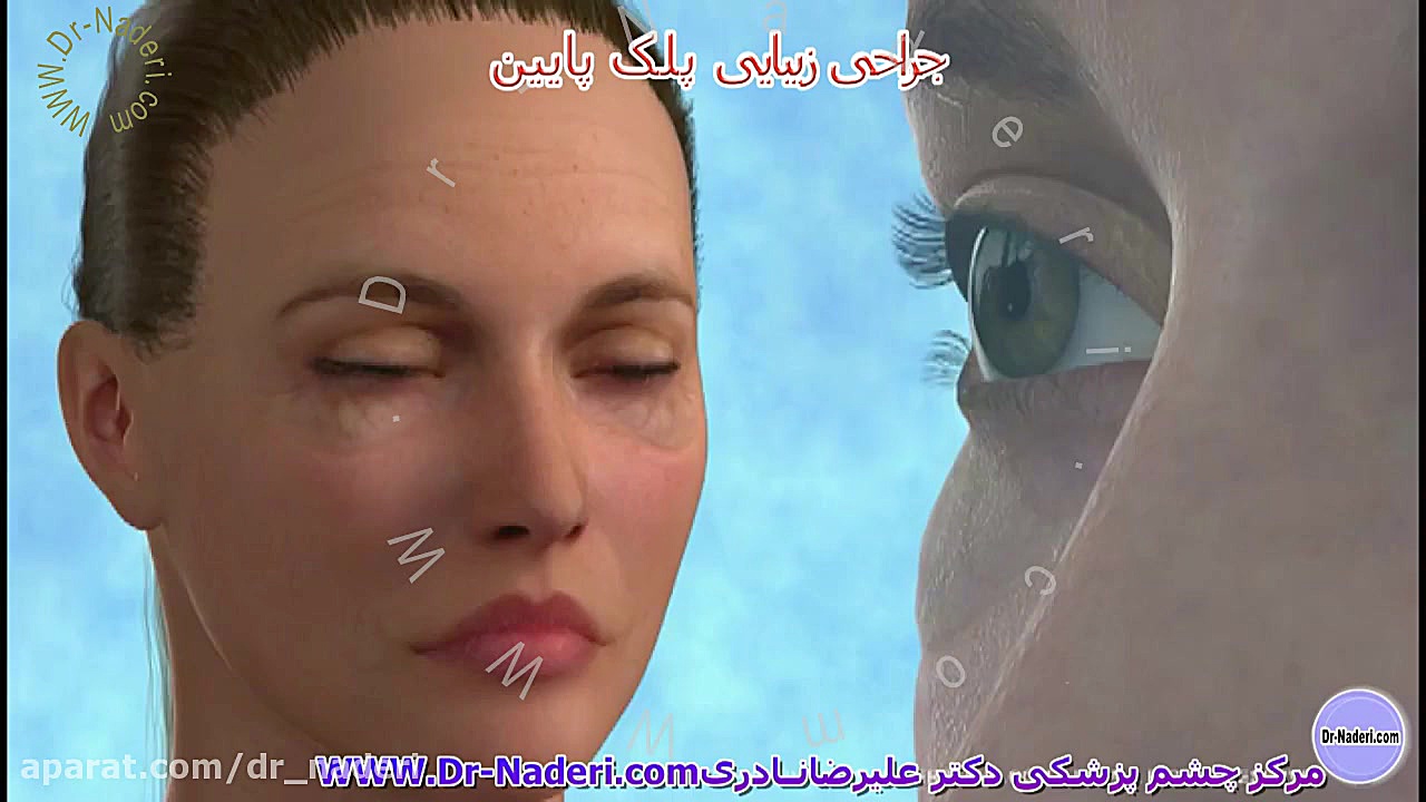 بلفاروپلاستی (جراحی زیبایی) پلک پایین -مرکز چشم پزشکی دکتر علیرضا نادری مرکز چشم پزشکی دکتر علیرضا نادری www.dr-naderi.com