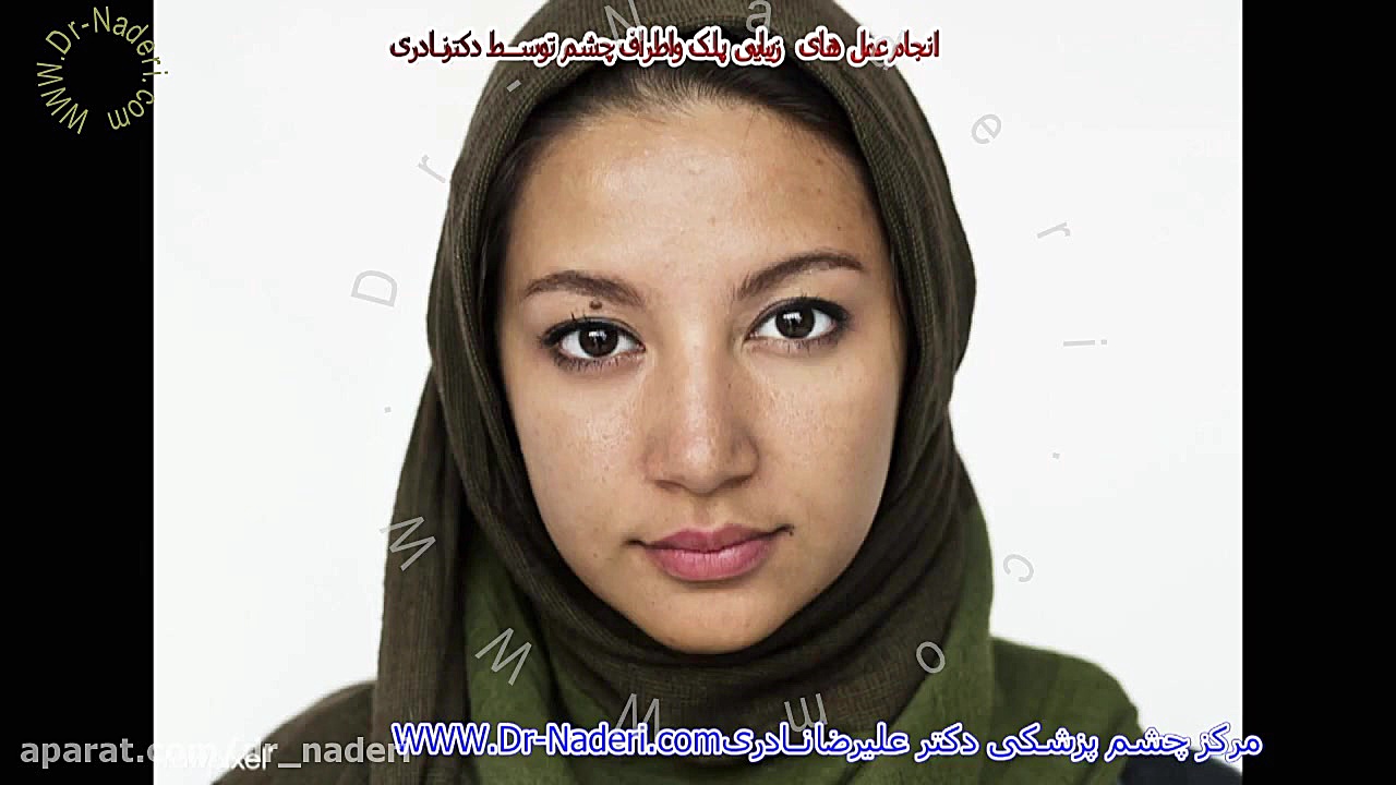 جراحی زیبایی پلک یا بلفاروپلاستی در مرکز چشم پزشکی دکتر علیرضا نادری مرکز چشم پزشکی دکتر علیرضا نادری www.dr-naderi.com