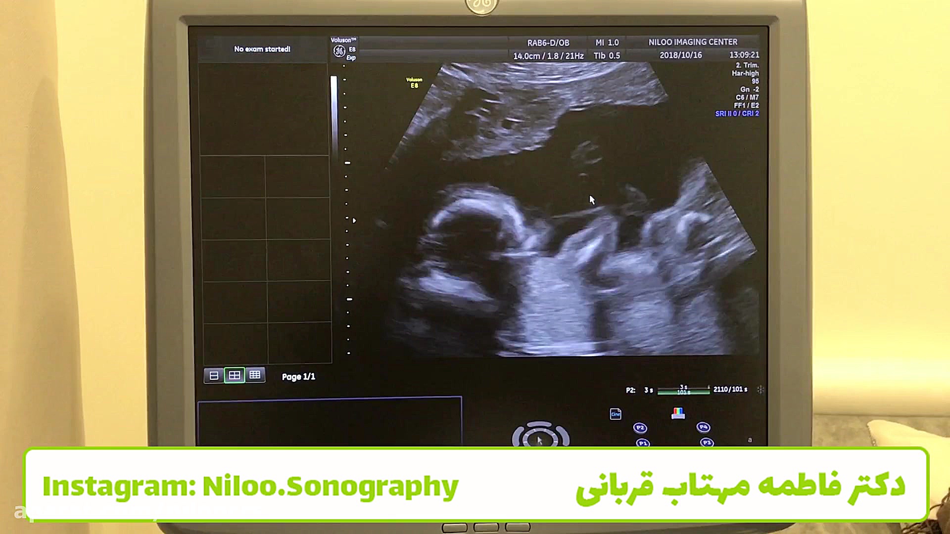 تعداد عروق بند ناف جنین پرتاب نعل