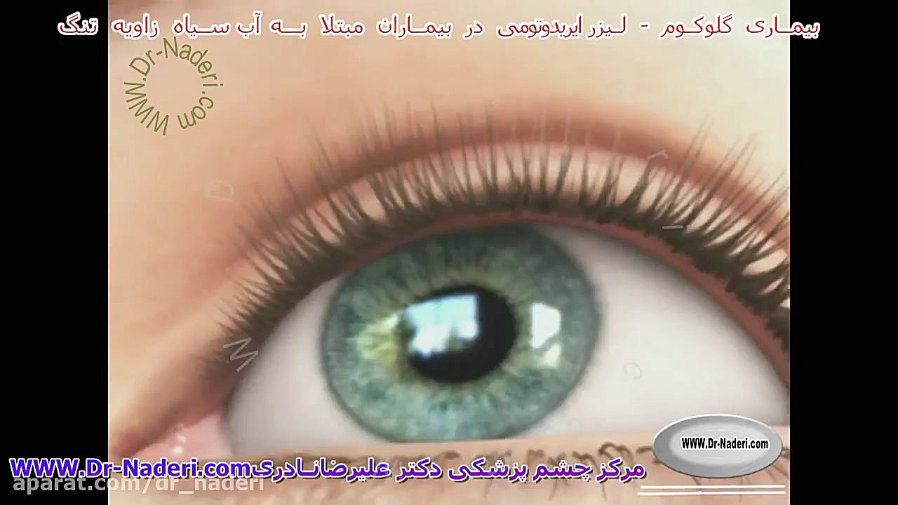لیزر یاگ در درمان آب سیاه - مرکز چشم پزشکی دکتر علیرضا نادری مرکز چشم پزشکی دکتر علیرضا نادری www.dr-naderi.com