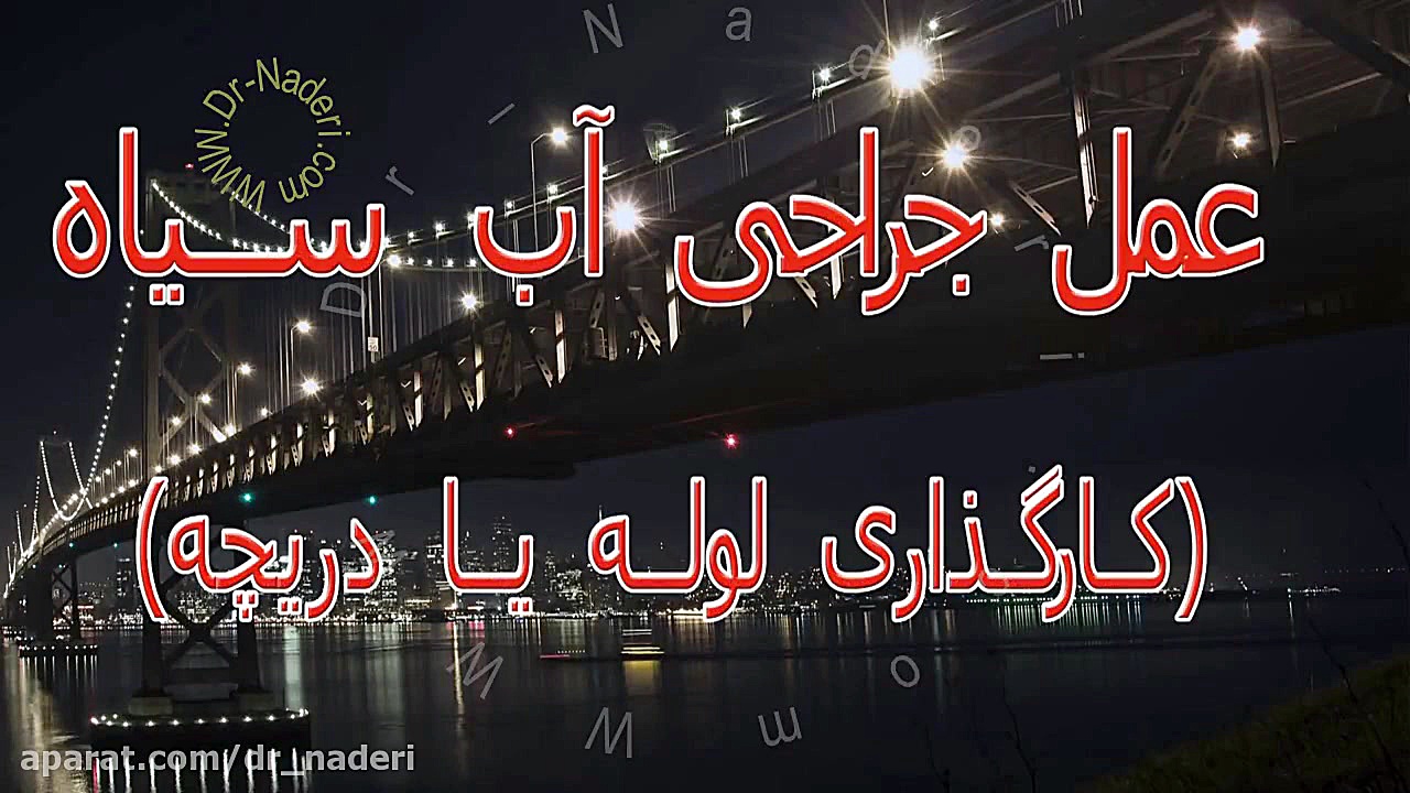 درمان آب سیاه با کارگذاری شانت - مرکز چشم پزشکی دکتر علیرضا نادری مرکز چشم پزشکی دکتر علیرضا نادری www.dr-naderi.com