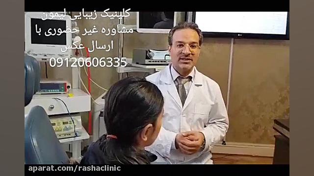 دو ماه بعد از انجام جراحی اصلاح گوش برجسته در کلینیک جراحی سر و گردن لیمون هایپرپاراتیروئیدیسم