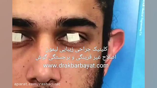 اصلاح بیرون زدگی و غیرقرینگی با جراحی زیبایی گوش در کلینیک تخصصی جراحی لیمون کاپوت سکودانئوم