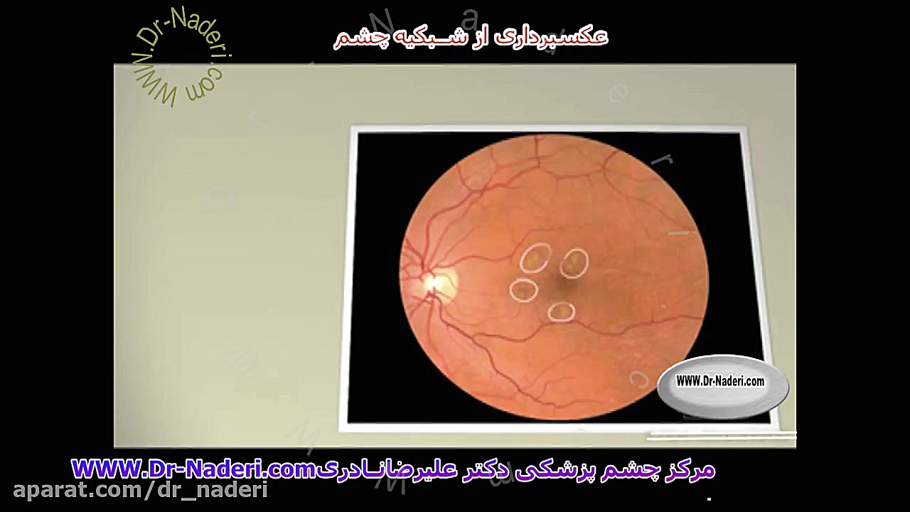 عکسبرداری از شبکیه - مرکز چشم پزشکی دکتر علیرضا نادری مرکز چشم پزشکی دکتر علیرضا نادری www.dr-naderi.com