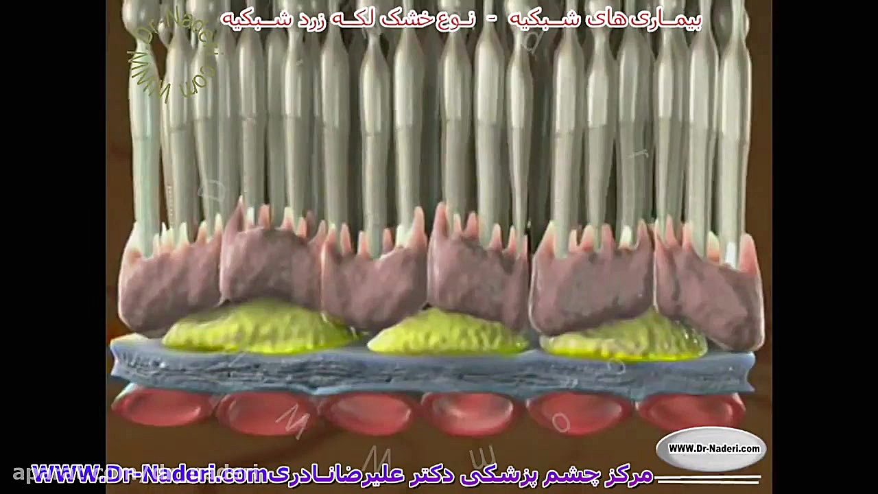 نوع خشک تخریب سنی لکه زرد شبکیه-مرکزچشم پزشکی دکترنادری مرکز چشم پزشکی دکتر علیرضا نادری www.dr-naderi.com