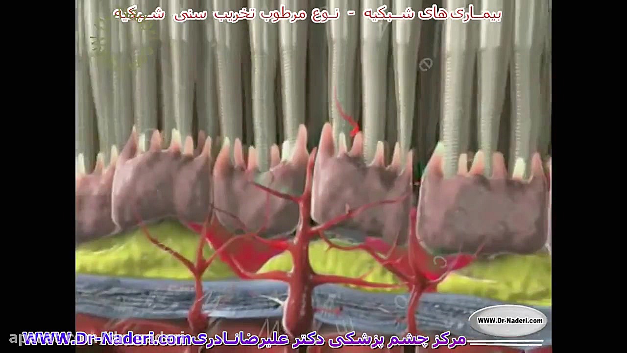 نوع مرطوب تخریب سنی لکه زرد - مرکزچشم پزشکی دکترنادری مرکز چشم پزشکی دکتر علیرضا نادری www.dr-naderi.com