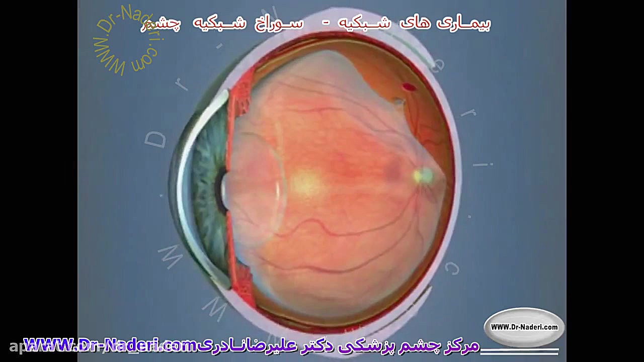سوراخ شبکیه - مرکز چشم پزشکی دکتر علیرضا نادری مرکز چشم پزشکی دکتر علیرضا نادری www.dr-naderi.com
