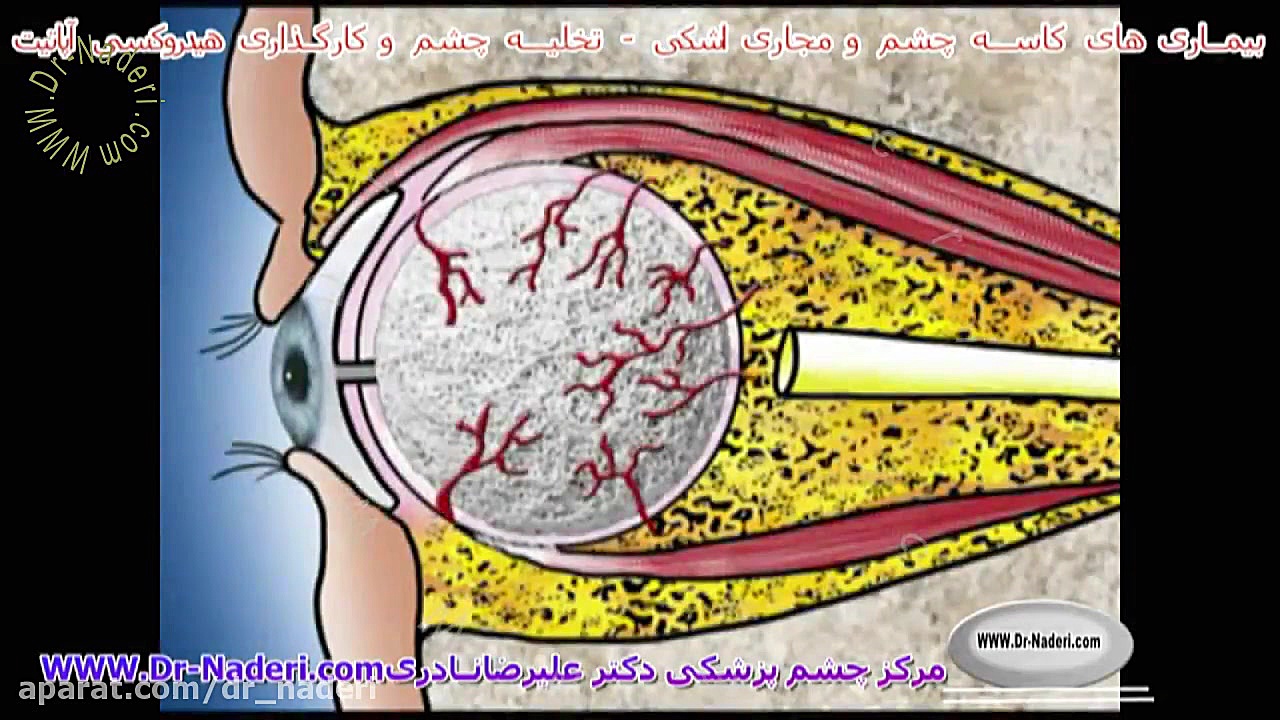 تخلیه چشم و کارگذاری هیدروکسی آپاتیت- مرکز چشم پزشکی دکتر نادری مرکز چشم پزشکی دکتر علیرضا نادری www.dr-naderi.com