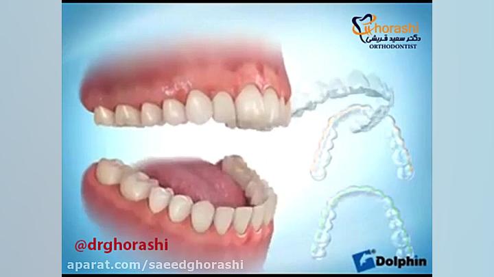 ارتودنسی نامرئی - دکتر سعید قریشی دکتر سعید قریشی