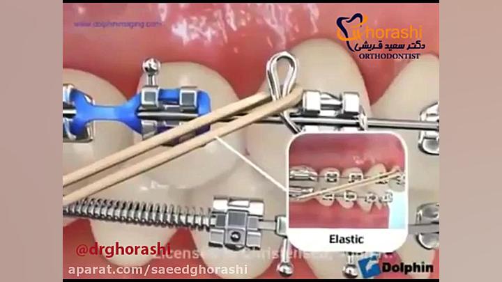 ابزار های مورد استفاده در درمان ارتودنسی - دکتر سعید قریشی دکتر سعید قریشی