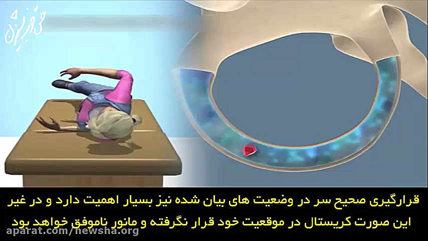 توانبخشی سرگیجه خوش خیم وضعیتی با استفاده از مانور لمپرت اتوپلاستی