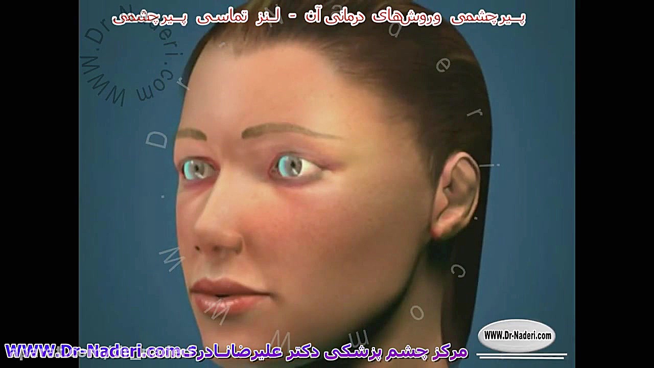 لنزهای تماسی پیرچشمی - مرکز چشم پزشکی دکتر علیرضا نادری مرکز چشم پزشکی دکتر علیرضا نادری www.dr-naderi.com