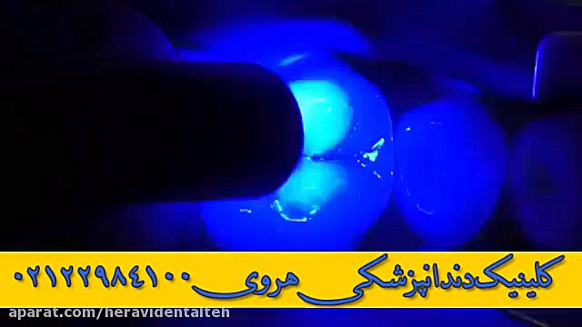 پر کردن دندان با کامپوزیت کاشت ریش