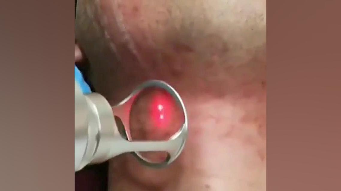 لیزر فرکشنال توسط متخصص پوست تهران دکتر سیما مسعودنیا