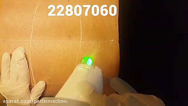 لیزرمو های زائد - کلینیک زیبایی پری سیما - 22807060 بلیچینگ
