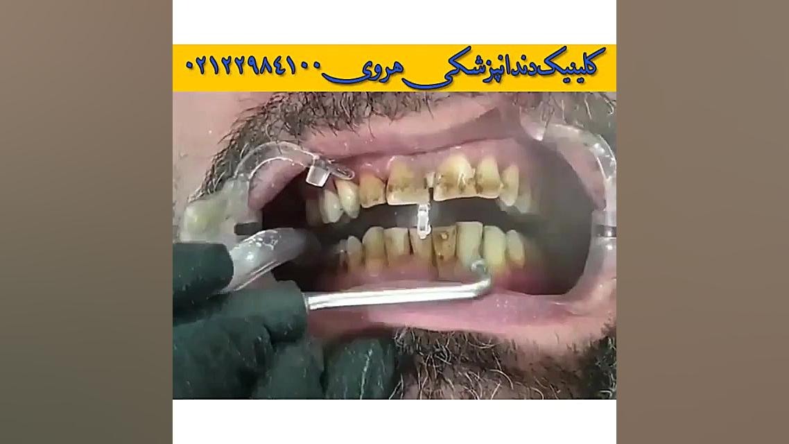 تاثیر جرم گیری دندان ها در سفیدی دندان ها توپوتیکان