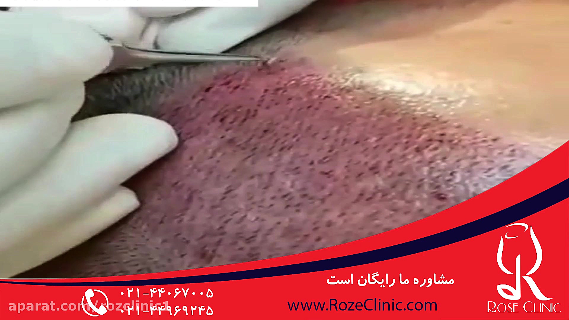 کاشت مو | فیلم کاشت مو | کلینیک پوست و مو رز | شماره 7 کلونیک اسپاسم
