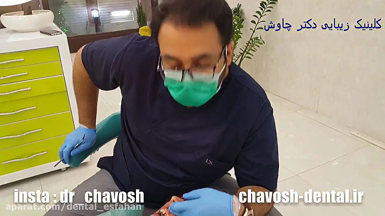 حذف پوسیدگی دندان و بازسازی تاج دندان با کامپوزیت ونیر در اصفهان درمان مهاری پیوندی