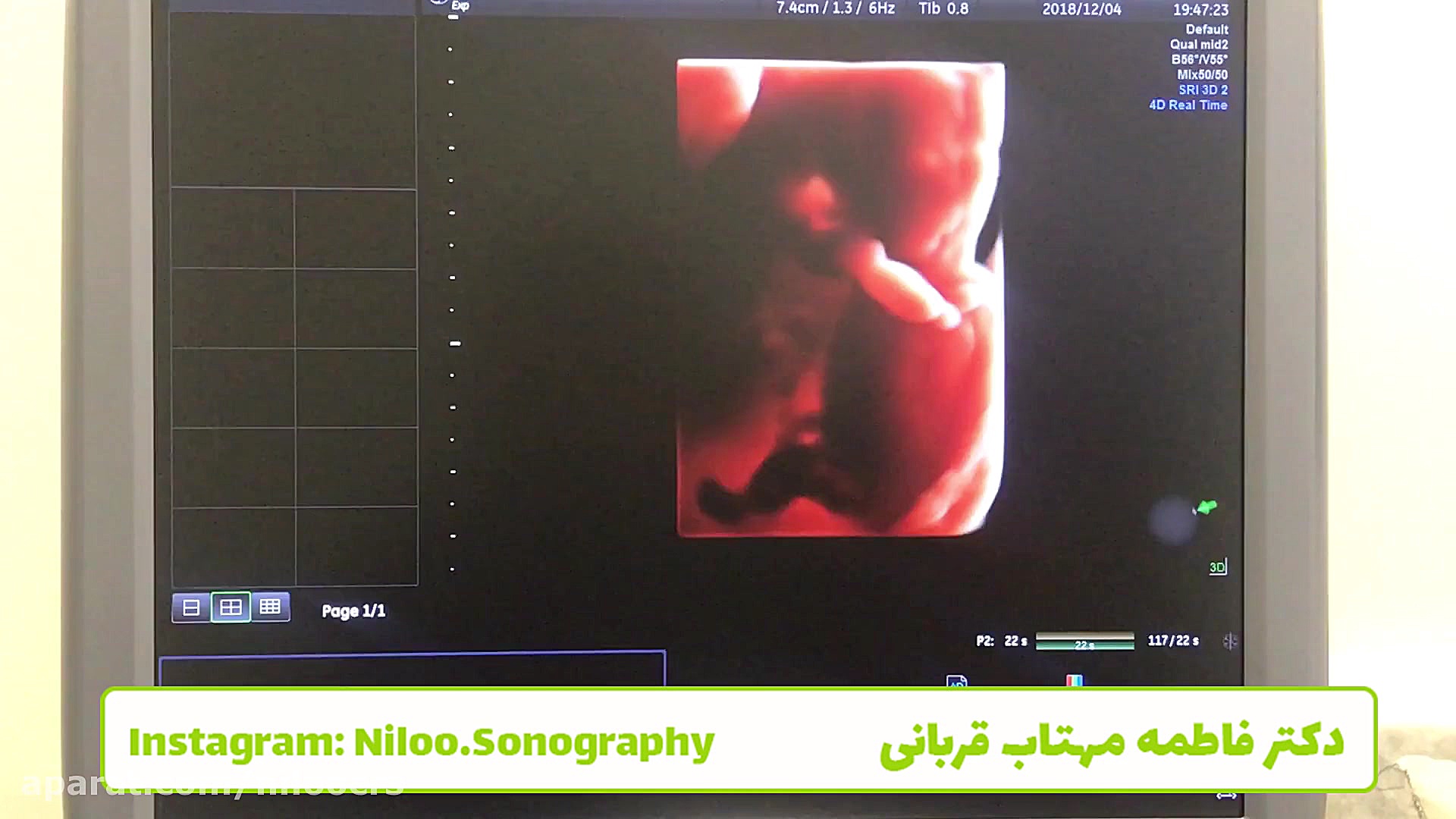 سونوگرافی جنین - اندازه گیری طول سرویکس سونوگرافی نیلو دکتر فاطمه مهتاب قربانی