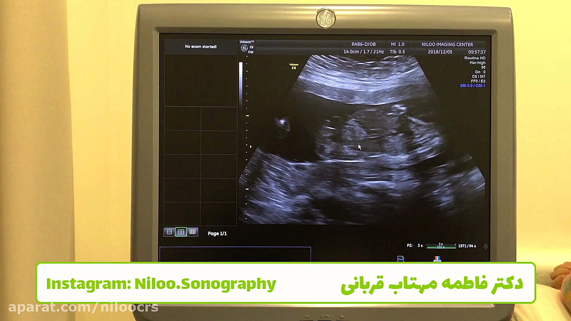 سونوگرافی جنین - کیست کروئید پلکسوس سونوگرافی نیلو دکتر فاطمه مهتاب قربانی