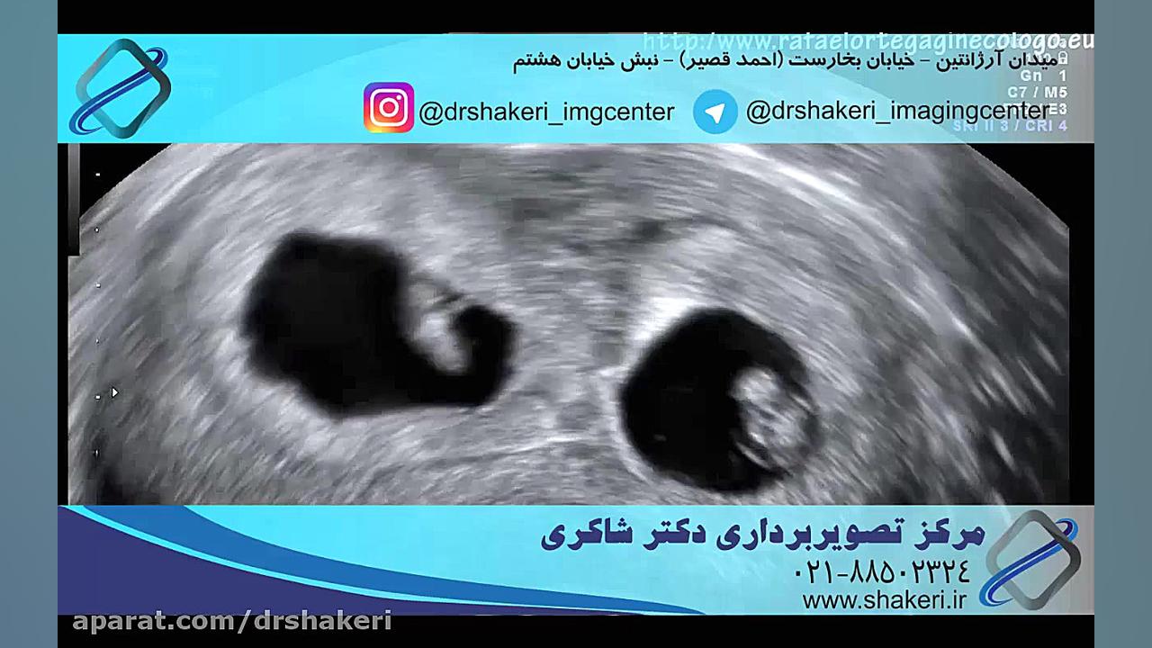 سونوگرافی 3 بعدی کربوکسی تراپی