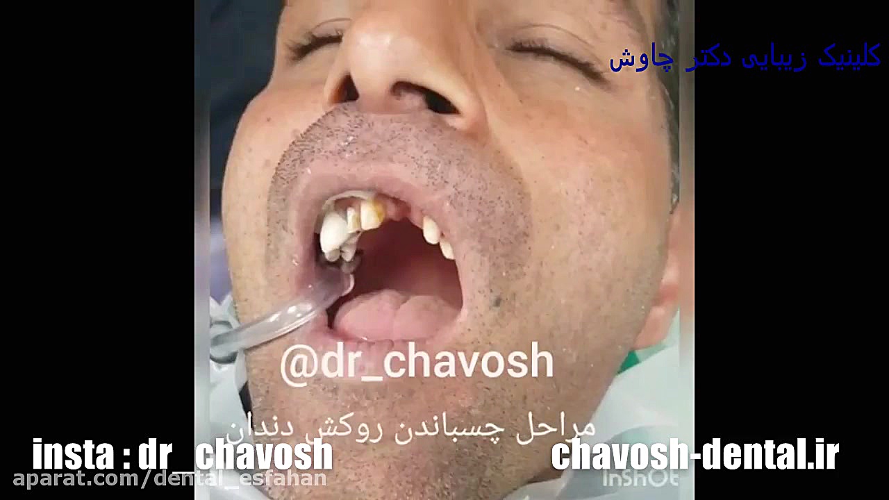 مراحل چسباندن روکش دندان - ایمپلنت در اصفهان - لمینت در اصفهان ایمونولوژی محاسباتی