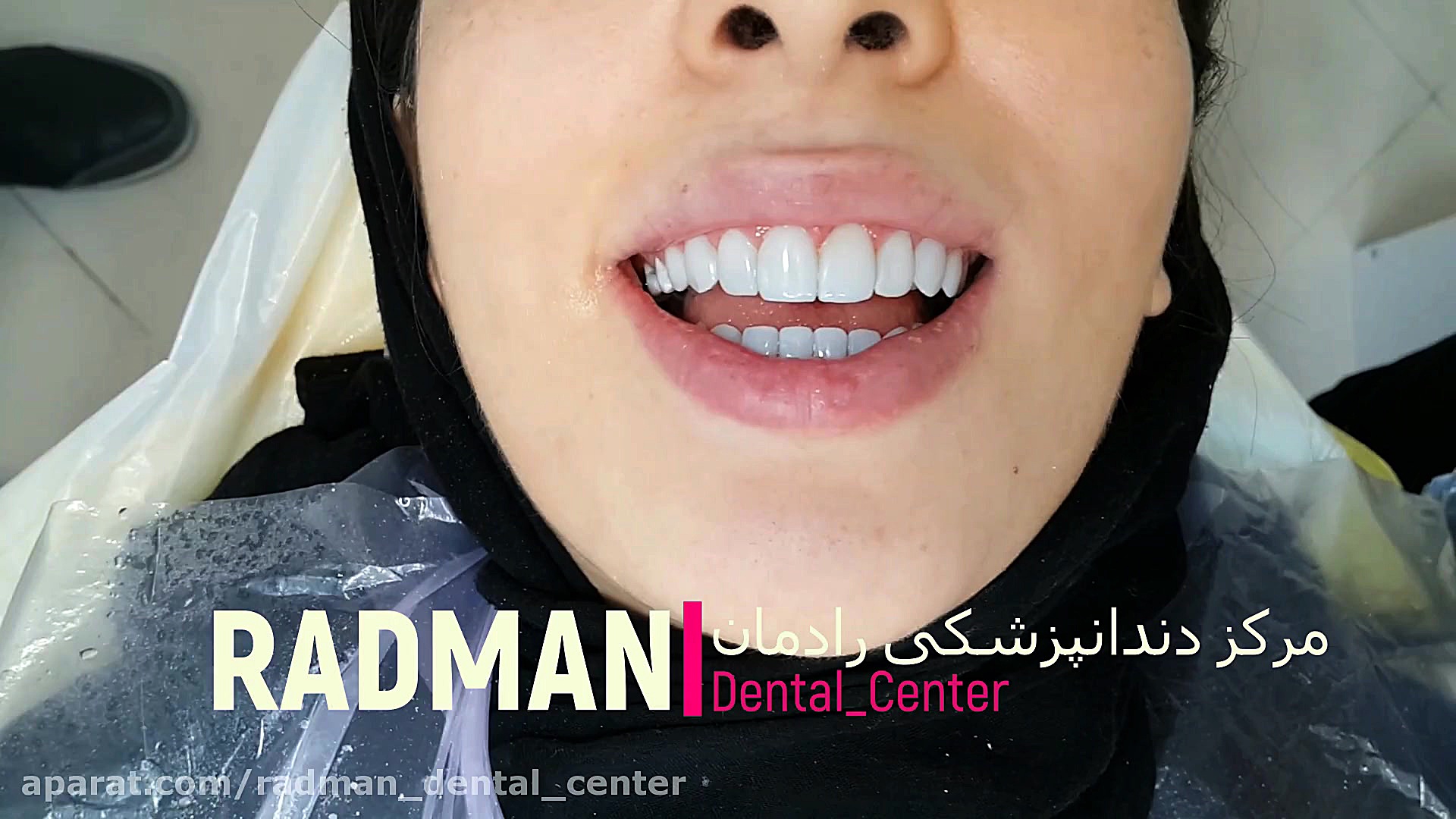 دندانپزشکی زیبایی کرج رادمان مایکروگناتیا