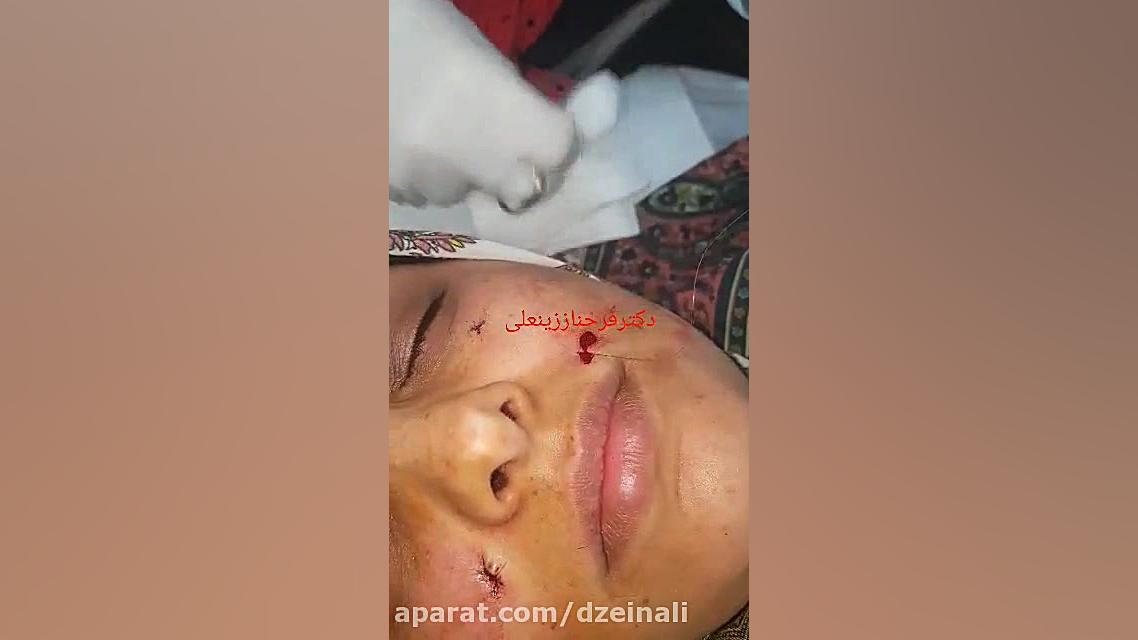 جراحی خال دکتر فرحناز زینعلی - متخصص پوست، مو، زیبایی زنجان