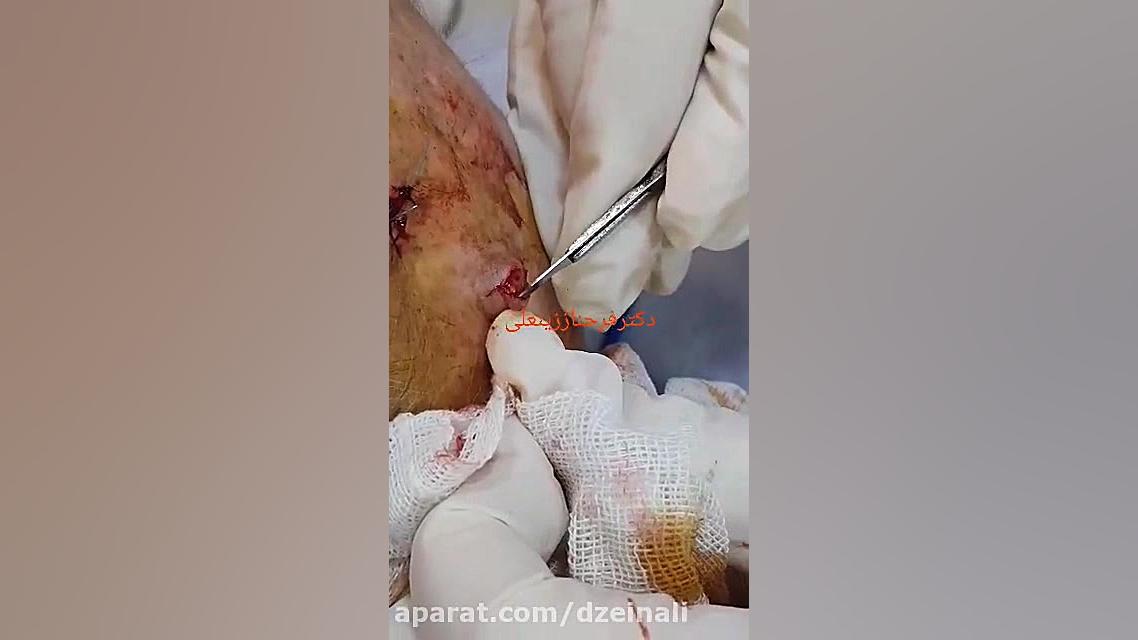 جراحی کیست مویی از سر دکتر فرحناز زینعلی - متخصص پوست، مو، زیبایی زنجان