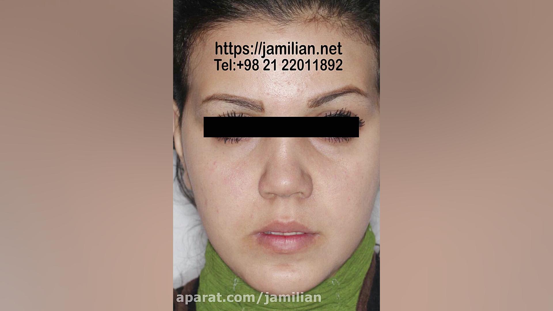 قبل و بعد از درمان ارتودنسی به همراه جراحی فک دکتر عبدالرضا جمیلیان - متخصص ارتودنسی