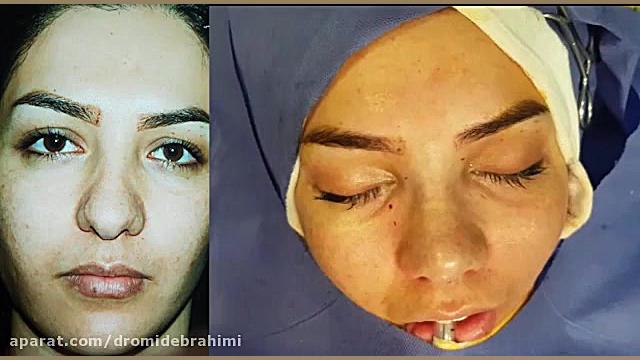 عمل زیبایی بینی توسط بهترین جراح بینی گوشتی، دکتر امید ابراهیمی دکتر امید ابراهیمی
