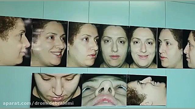 جراحی بینی استخوانی قوزدار، توسط دکتر امید ابراهیمی بهترین جراح بینی استخوانی دکتر امید ابراهیمی
