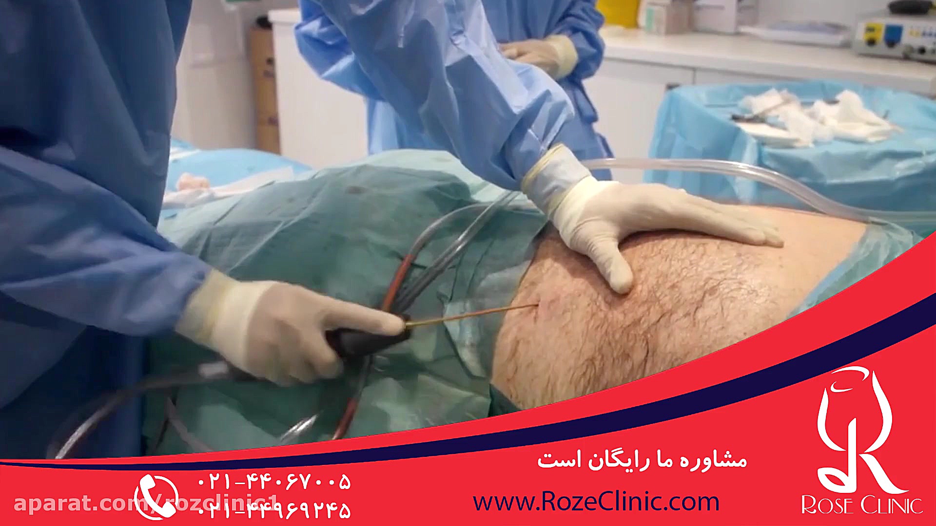 لیپوماتیک | فیلم لیپوماتیک | عمل لیپوماتیک | کلینیک پوست و مو رز | شماره 4 اینسایزینگ