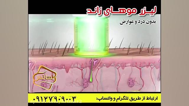 فیلم لیزر موهای زائد-کلینیک رنسانس دیسمورفی فاسیال