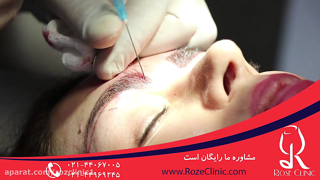 کاشت ابرو | فیلم کاشت ابرو | کلینیک پوست و مو رز | شماره 30 دندانپزشک زیبایی
