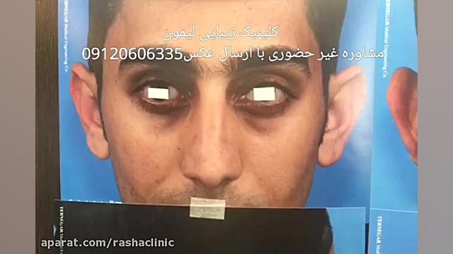 جراحی زیبایی گوش برای عزیزان شهرستانی پروتز سینه
