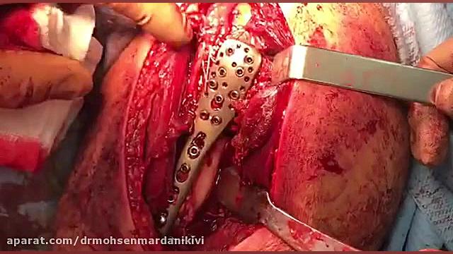 جراحی شکستگی پروگزیمال هومروس پیلینگ