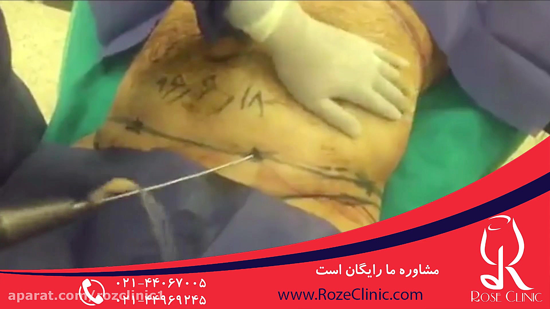لیپوماتیک | فیلم لیپوماتیک | عمل لیپوماتیک | کلینیک پوست و مو رز | شماره 6 جراحی لثه