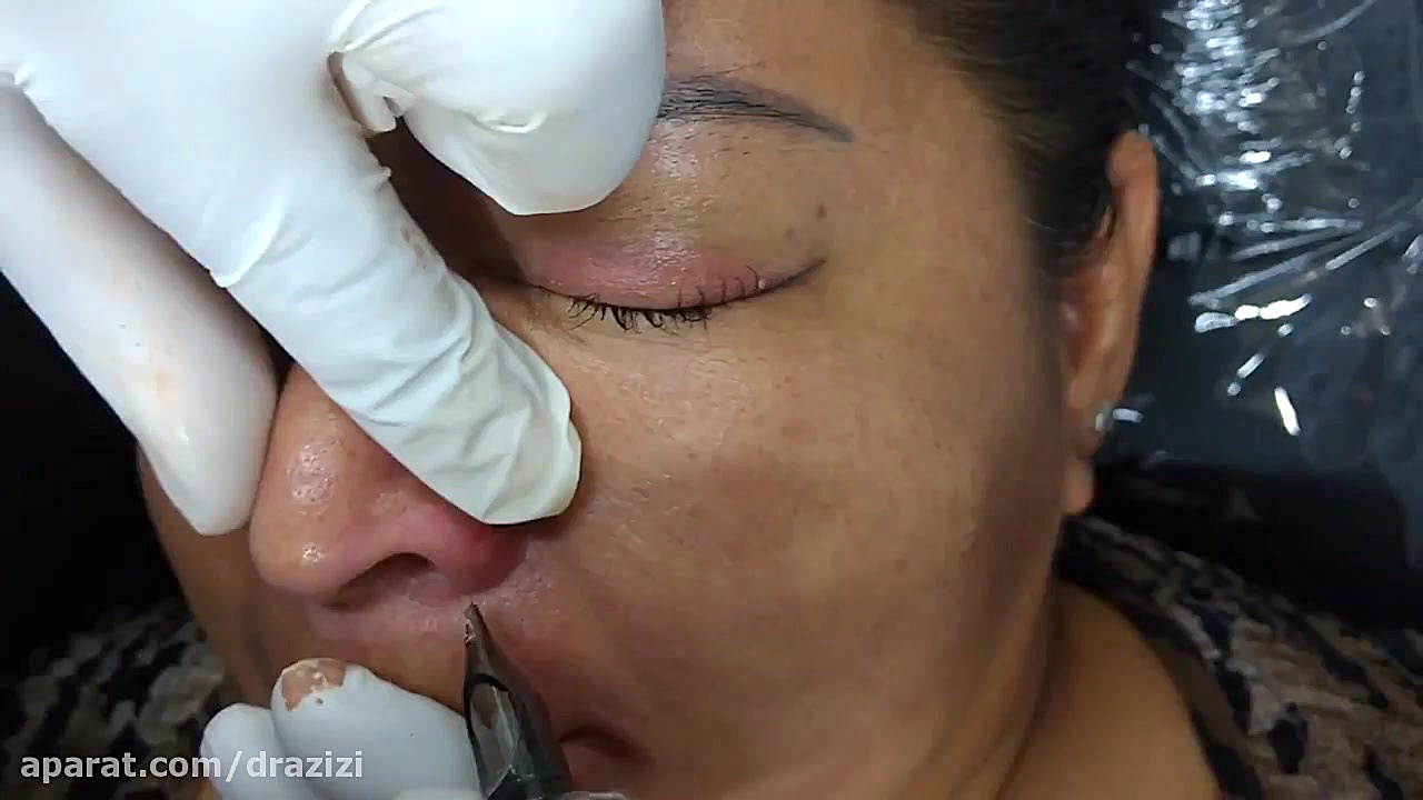 میکروپیگمنتیشن ویتیلیگو نوید محمدزاده