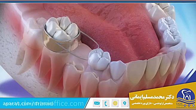 استفاده از فضانگهدارنده در دندان های کودکان دکتر محمد مسلم ایمانی - متخصص ارتودنسی در کرمانشاه